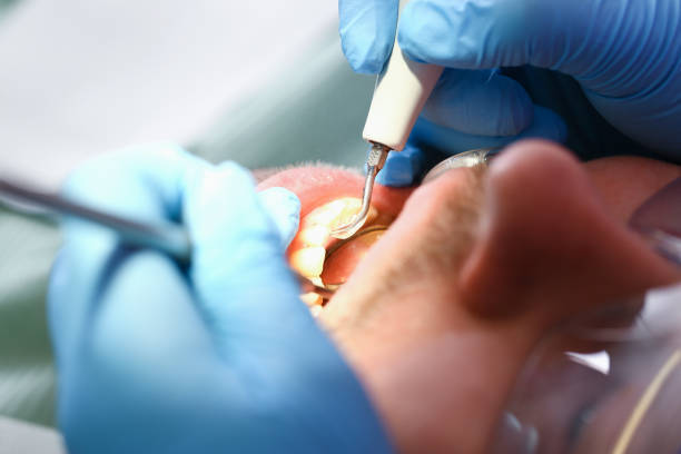 Best Emergency Root Canal Treatment in Salineville, OH